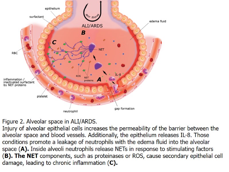 Figure 2. Alveolar space in ALI/ARDS. Injury of alveolar epithelial cells increases the permeability